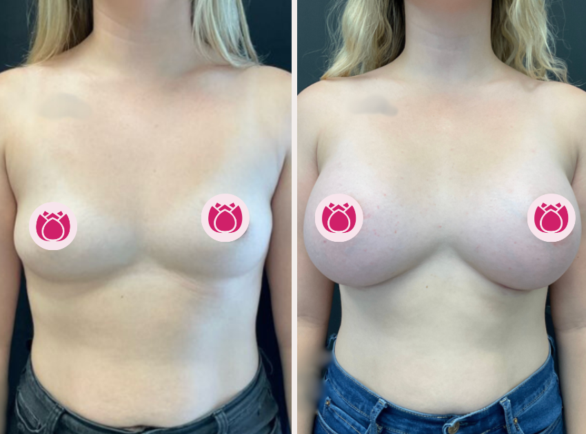 Breast augmentation before and after, patient 2