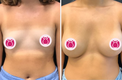 Breast augmentation before and after, patient 4