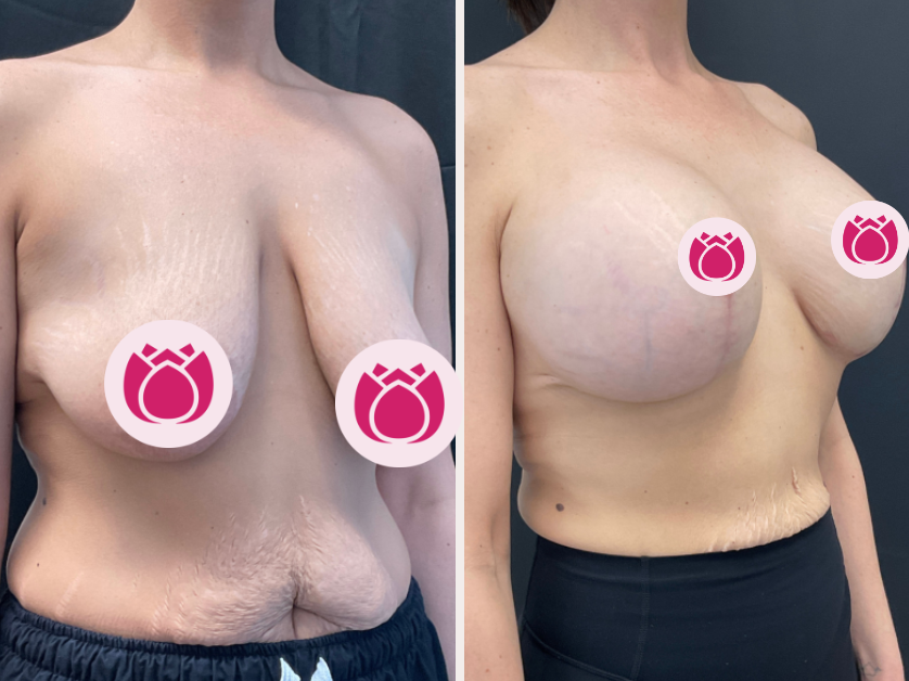 Breast augmentation before and after, patient 1