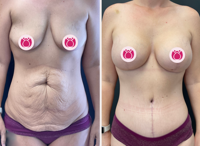 Tummy tuck before and after, patient 1
