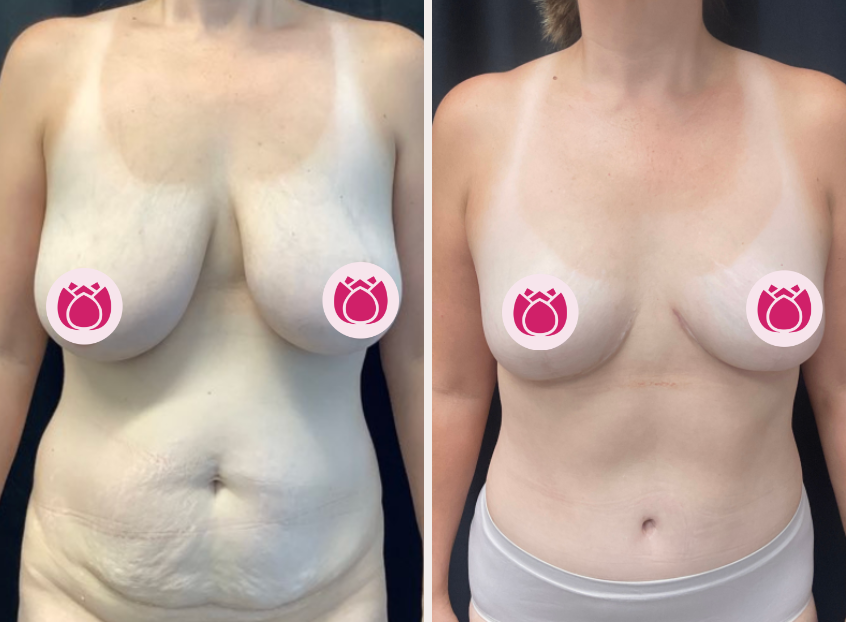 Tummy tuck before and after, patient 2