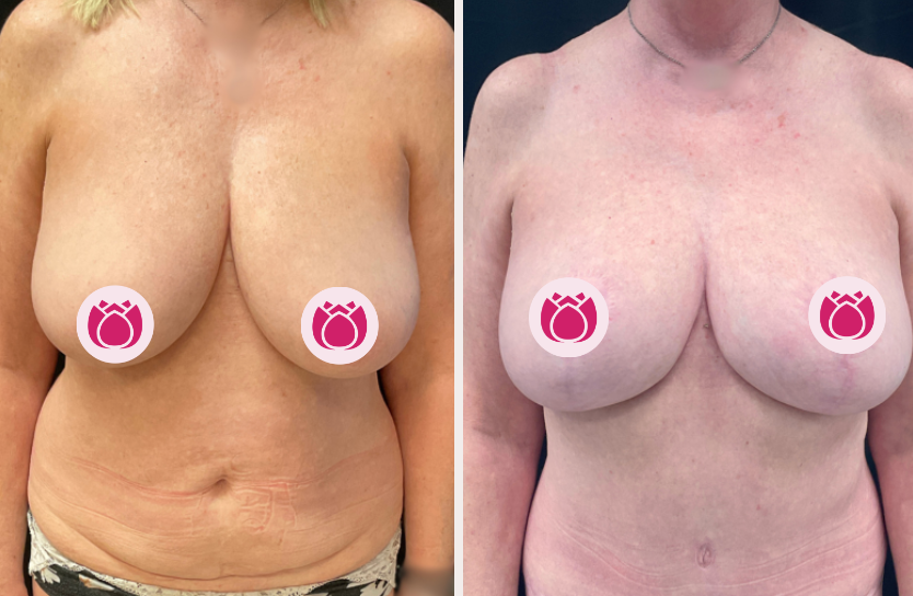 Tummy tuck before and after, patient 3