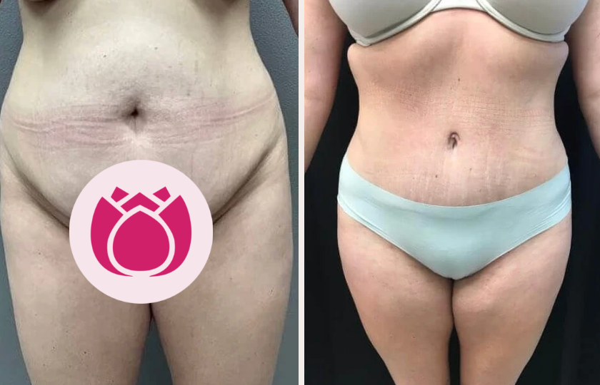 Tummy tuck before and after, patient 4